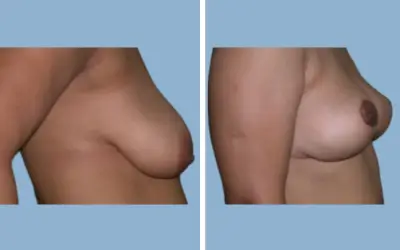 Before and After